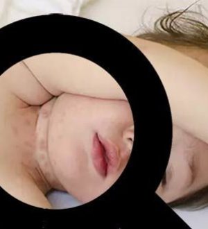 Детская Сыпь На Шее: Причины, Симптомы И Лечение